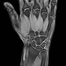 снимок МРТ лучезапястного сустава